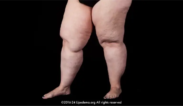 Lipedema medial knee fat pads and nodular fat texture.