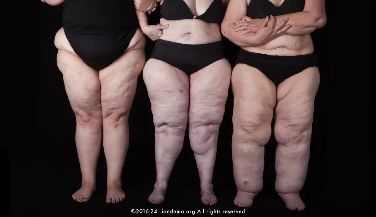 Lipedema different body types