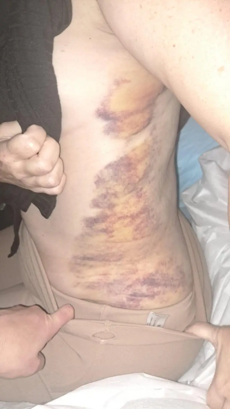 Post op brusing Lipedema Surgery