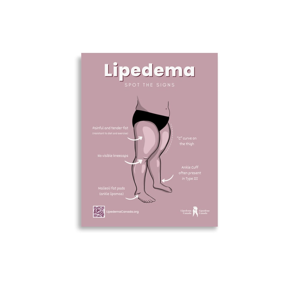 Lipedema: Spot the Signs Poster_Stage 2 11X14"